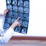 el seguro cubre enfermedades cerebrovasculares